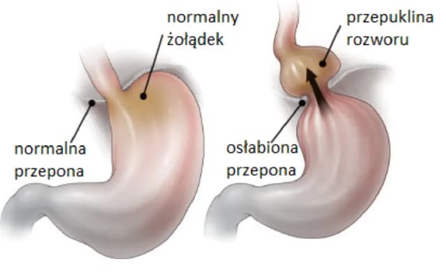 Przepuklina jaki lekarz - kogo wybrać, aby uniknąć problemów zdrowotnych